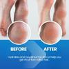 Callus Remover for Feet Extra Strength Pedicure Grade - Foot and Toe Callus Remover Softener - Professional Callus Treatment for Toes, Heels, and Hands - Cuticle Remover & Softener view 2