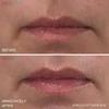 MesoLyft Lips 5 ML (5 ML) Lip Plumper view 4