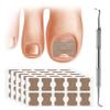 FERYES 50 PCS Breathable Ingrown Toenail Corrector Patch with Double-Ended Stainless Steel Toenail Lifter  Comprehensive Toenail Care Solution view 1