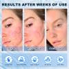 Azelaic Acid 10% Cream for Face - Acne Cream for Rosacea Reducing Relief Pimple Breakouts Blackhead Pigmentation and Redness - Azelaic Acid Gel For Facial and Skin Care view 4