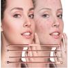 Euxor, Blackhead Remover Pimple Comedone Extractor Tool Best Acne Removal Kit - Treatment for Blemish, Whitehead Popping, Zit Removing for Risk Free Nose Face Skin with Case (Rose, 4 Piece Set) view 2