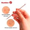 Euxor, Blackhead Remover Pimple Comedone Extractor Tool Best Acne Removal Kit - Treatment for Blemish, Whitehead Popping, Zit Removing for Risk Free Nose Face Skin with Case (Rose, 4 Piece Set) view 4