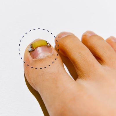 NinthAvenue Basics [XS/0.63inches/15-17mm] Ingrown toenail treatment by latex ring elasticity, usable in everyday life, Ingrown toenail corrector, Yellow/Silver