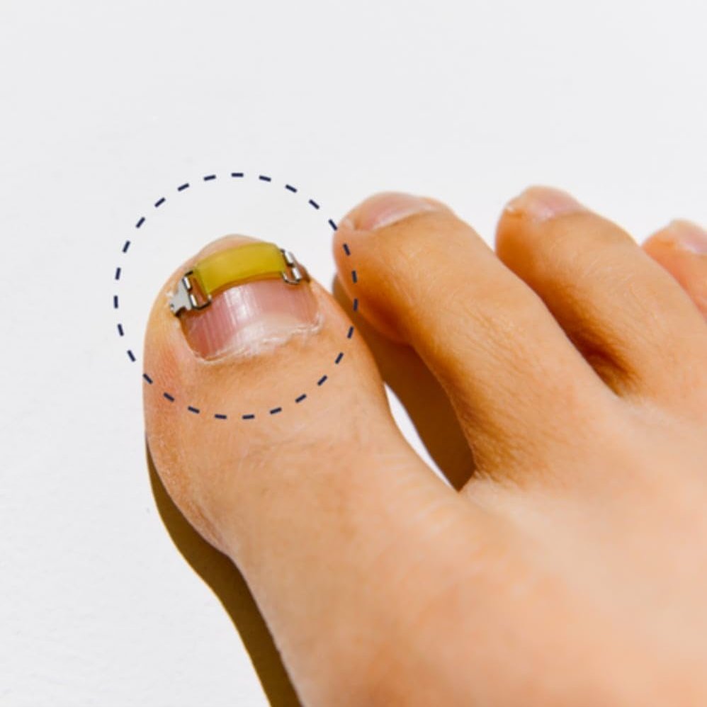 NinthAvenue Basics [XS/0.63inches/15-17mm] Ingrown toenail treatment by latex ring elasticity, usable in everyday life, Ingrown toenail corrector, Yellow/Silver