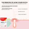 Pimple Patches for Face, 200Pcs Hydrocolloid Acne Pimple Patch Cute Zit Patches for Covering Zits and Blemishes, Colorful Spot Stickers for Covering Zits - Pimple Popper Tool Kit (Stars) view 3