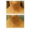 Cold Plasma Plus+ Neck & Chest Broad Spectrum SPF 25, 2 fl. oz. view 4