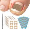 FVION Ingrown Toenail Corrector Set - 41 Pcs Pain-Free Ingrown Toenail Straightener Strips with Toenail Lifter - Effective Solution Ingrown Toenail Tools Kit view 1