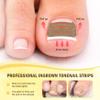 FVION Ingrown Toenail Corrector Set - 41 Pcs Pain-Free Ingrown Toenail Straightener Strips with Toenail Lifter - Effective Solution Ingrown Toenail Tools Kit view 4