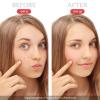 Dark Spot Remover for Face and Body - Dark Spot Corrector Serum for Acne Scars, Melasma, Age, Sun, Black Spots | Advanced Formula for Women and Men |Suitable for Oily, Dry and Combination Skin, 1.35FL view 4