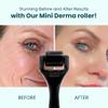 Gin Amber Beauty Mini Derma roller (0.25mm) - 48 Real Individual Needles, Microdermabrasion Device for Skin Care, Serum Absorption with Microneedling, Tool, Hygienic Case (Black Mini 0.25mm) view 2