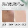 Acne Treatment for Face Skin Care Sets & Kits with Cleanser Toner Serum Gel for Teens 10-12 Girls Boys Christmas Gifts view 3