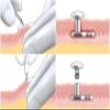AccGin Disposable Biopsy Punch Sterile Biopsy Dermal Punch for Piercing, Stainless Steel Skin Piercing Tool with Protective Handle 1pc view 3