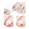 DeaHea 10 Pack Ingrown Toenail Lifter Precision Ingrown Toenail Removal Kit Nail Cleaner Pedicure Tools for Ingrown Toenail Corrector Set Ingrown Toenail Treatment Toenails Straightener Strips view 3
