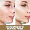 14% Azelaic Acid Skin Perfecting Cream, Reduces Redness, Fades Dark Spots, Evens Texture - Tried and True view 4