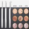 Blackhead Remover Tweezer Kit, 8 Pcs, Comedone Extractor, Whitehead Acne Blemish Pimple Remover view 2