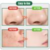 xwxwseui Usiveinborn Blackhead Remover Upgraded, Usiveinborn Blackhead Tweezers, Professional Upgraded Facial Blackhead Remover Tweezers, Blackhead Remover Tools Sets (A1-Silver-3pcs) view 4