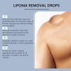 Herbal Lipoma Removal Drops,Lipoma Removal,Lipoma Removal Cream,Creating Perfect Skin,50ML/1.69FL.OZ (2pcs) view 4