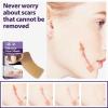 ChuYiElegance Multi-Use Silicone Strips for Keloid Repair and view 4