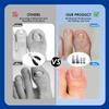 Titanium Alloy Ingrown Toenail Treatment, Nail Tools, and Ingrown Toenail Removal Kit Specially Designed for Curved Nail Repair and Ingrown Toenail Corrector view 4