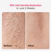 IPL Laser Hair Removal for Women and Men, 25J Triple-Pulse Permanent Hair Removal Device for Ingrown & Coarse Hair, 37F Painless Sapphire Ice Cooling Hair Removal for Legs, Facial, Armpits, Bikini view 3
