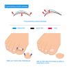 Ejoyous Ingrown Nails Correction Wire Kit, 12Pcs Toenail Correction Tool, 6 Sizes Ingrown Wire Fixer, Ingrown Toenail Removal Kit, Foot Care view 4
