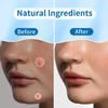 REDANHA 180 Count Original Pimple Patches for Face, Hydrocolloid Acne Pimple Patch with Tea Tree Oil for Party Gift Covering Zits Blemishes view 4