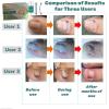 Ingrown Toenail Corrector & Removal Kit - at Home Treatment for Ingrown Toenails, Titanium Alloy Ingrown Toenail Treatment Tools, Nail Tools Designed for Curved Nail Repair Suitable for Men Woman view 4
