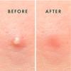 Aayuleubeda Badi Care ABC Pimple Patches (36 Count) view 3