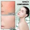 Fusang 8Pcs Aloe Vera Gel for After Sun Skin Care view 3