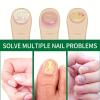 72 Pcs Nail Repair Patches, Nail Repair for Damaged Nails and Appearance of Discolored view 3