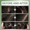 ABERA High-Performance Anti-Dandruff Shampoo with Langbian Ginseng Extract, Sulfate Free Paraben Free, 5,07 Fl Oz |2 Box + Free 1 Hair Growth Serum| view 4
