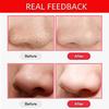 Blackhead Remover Vacuum, Acne Comedone Extractor Tool USB Rechargeable Pore Cleaner Electric Blackhead Suction Instrument with 3 Adjustable Suction Power and 3 Replacement Probes view 4