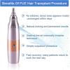 Hair Follicle Extractor, Seamless Hair Transplant Machine, Instrument Hair Hairline Extractor with Pedals, Speed Mode 3 Gears Adjustment & Safe Without Scars, for Prevent Hair Loss In Men and Women view 3