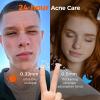 TKTK Bulk Acne Patches for Face 435 Count + Large Pimple Patches 62 Count, Zit Stickers for Covering Zits, Blemishes and Breakouts view 4