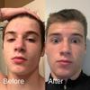 Acne System for Men and Boys, Face Wash, Moisturizer, Pimple Patches, Shield Men's Skin Care Set (2 Months) view 3