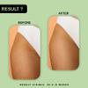 Ayumcure Stretch Mark Removal & Prevention Oil for women | 100ml | Improves Skin Texture & Tone | Nourishing Blend with Natural Oils | Hydrating & Elasticity Support (Pack of 2) view 4