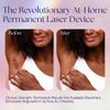 Epilaser Dark Skin At-Home Laser Hair Removal, Safe - Wont Cause Skin Bleaching, Hypopigmentation | Intelligent, Clinical Strength, Painless Permanent Hair Removal for Face, Body, Bikini Line view 3