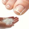 20 Ingrown Toenail Correction, Toenail Straightener Strips and Recovery Tool view 1