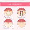 Acne Pimple Patches (144 Count) Hydrocolloid Acne Patches for Face, Invisible & Waterproof, Fast Absorbing Zit Stickers for Pimples, Blemishes & Whiteheads Day & Night Treatment view 3