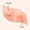 a.l.m. Magical Patch: Hydrocolloid pimple patches. These ultra thin & translucent hydrocolloid adhesive covers and absorb unwanted pimples. Parches Para Acne for skincare. view 4