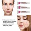 Azelaic Acid for Face Balance Skin Tone & Cleanse Pores, Azelaic Acid Serum Acido Azelaico-Relieve Acne, Blackhead & Redness,Premium Skin Care, 20g (1 PCS) view 4