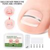 Nail Correction Patch | 10 Piece Correction Patches for Toe Nails | Corrector Strips Stickers for Repair Care Women Men Adult Foot Home view 4