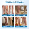AFGAFG Timilk Varicose Veins Treatment for Legs - Improves Blood Circulation, Professional Varicose Veins Treatment Cream, varicose veins cream Suitable for All Skin Types - 50ml (2 Bottle) view 2
