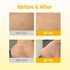 Acropass Dark Spot Microcone Patch for the Appearance of Post-Blemish Marks & Redness with Vitamin C Derivative, Niacinamide, Dermatologist Tested, Non-Irritating, Cruelty-Free (12 Patches) view 3