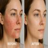 Acne Spray  Live Probiotic Culture Mist for Breakouts, Redness & Oily Skin | Natural 4 oz Clearing Treatment view 4