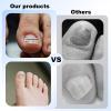 9pcs Ingrown Toenail Corrector Kits, 3 Sizes 9 Titanium Alloy Strips 10 Auxiliary Stickers 1 Nail File Practical Tools for Curved Nail Repair Straightener Brace view 4