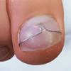 Nail Correction Round Wire  Adjustable Ingrown Toenail Brace for Gentle & Effective Nail Growth Correction - Prevents Further Ingrowth, Restores Natural Nail Shape, 25m Rolll, 0.3mm Thickness view 3