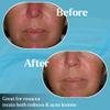 Advanced Pyratine A1 Soft Crme - Cytokinin Antiaging & Rosacea Treatment - Skin Cream Reduces Facial Redness, Acne Lesions, Spider Veins, Fine Lines, Wrinkles, & Mottled Hyperpigmentation - 2 oz. view 4