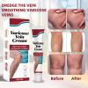2PCS Varicose Veins treatment for legs,Anti Varicose Vein Soothing Leg Cream,Improves Blood Circulation, Reduces Varicose Veins and Heaviness Lymphatic Massage Cream 20G/0.70OZ view 4