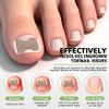 BALUCA 2025 Upgraded Ingrown Toenail Corrector Kit | Professional Ingrown Toenail Treatment & Pain Relief | Home Pedicure Tool Set with Breathable Corrector Strips & Toenail Tools view 2